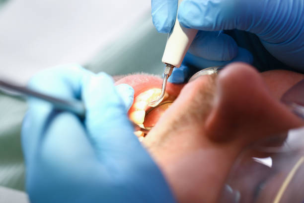 Best Emergency Root Canal Treatment in Sterling, VA