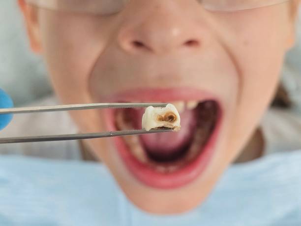 Best Emergency Dental Care for Abscessed Tooth in Sterling, VA